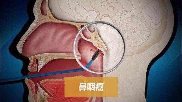 EB病毒一般几天能好